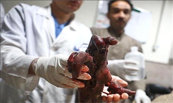 دست یک جوان ارومیه ای بر اثر استفاده از مواد محترقه قطع شد